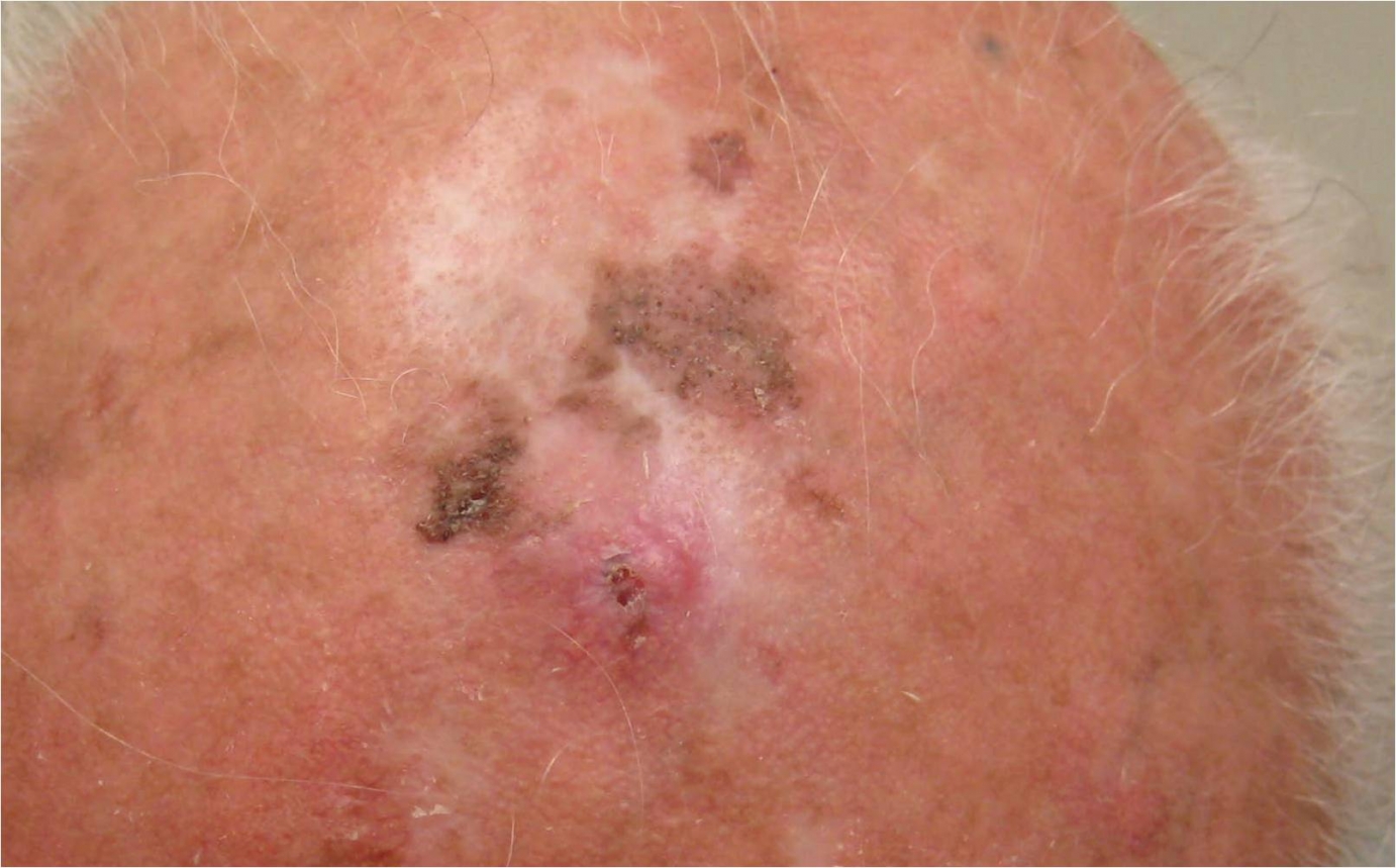 Squamous Cell Carcinoma | Skin Cancer Institute